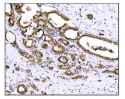 IHC staining of FFPE human breast cancer tissue with Prolyl Endopeptidase antibody. HIER: boil tissue sections in pH8 EDTA for 20 min and allow to cool before testing.