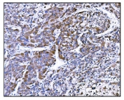 IHC staining of FFPE human liver cancer tissue with Prolyl Endopeptidase antibody. HIER: boil tissue sections in pH8 EDTA for 20 min and allow to cool before testing.