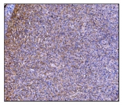 IHC staining of FFPE human skin cancer tissue with Prolyl Endopeptidase antibody. HIER: boil tissue sections in pH8 EDTA for 20 min and allow to cool before testing.