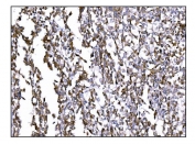 IHC staining of FFPE human pancreatic cancer tissue with Prolyl Endopeptidase antibody. HIER: boil tissue sections in pH8 EDTA for 20 min and allow to cool before testing.