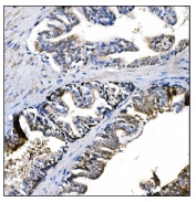 IHC staining of FFPE human prostate cancer tissue with Prolyl Endopeptidase antibody. HIER: boil tissue sections in pH8 EDTA for 20 min and allow to cool before testing.