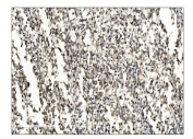 IHC staining of FFPE human bladder cancer tissue with SUMO2/3 antibody. HIER: boil tissue sections in pH8 EDTA for 20 min and allow to cool before testing.