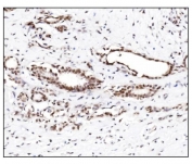 IHC staining of FFPE human breast cancer tissue with SUMO2/3 antibody. HIER: boil tissue sections in pH8 EDTA for 20 min and allow to cool before testing.