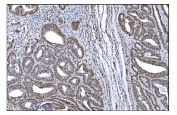 IHC staining of FFPE human rectal cancer tissue with SRF antibody. HIER: boil tissue sections in pH8 EDTA for 20 min and allow to cool before testing.