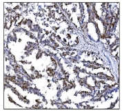 IHC staining of FFPE human ovarian cancer tissue with SRF antibody. HIER: boil tissue sections in pH8 EDTA for 20 min and allow to cool before testing.