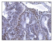 IHC staining of FFPE human endometrial cancer tissue with SRF antibody. HIER: boil tissue sections in pH8 EDTA for 20 min and allow to cool before testing.