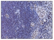 IHC staining of FFPE human gallbladder adenocarcinoma tissue with SRF antibody. HIER: boil tissue sections in pH8 EDTA for 20 min and allow to cool before testing.