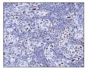 IHC staining of FFPE human gallbladder adenocarcinoma tissue with SRF antibody. HIER: boil tissue sections in pH8 EDTA for 20 min and allow to cool before testing.