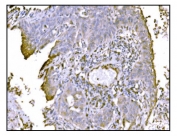 IHC staining of FFPE human lung cancer tissue with TRAP alpha antibody. HIER: boil tissue sections in pH8 EDTA for 20 min and allow to cool before testing.