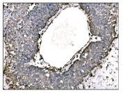 IHC staining of FFPE human liver cancer tissue with TRAP alpha antibody. HIER: boil tissue sections in pH8 EDTA for 20 min and allow to cool before testing.