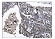 IHC staining of FFPE human ovarian serous adenocarcinoma tissue with KMT1B antibody. HIER: boil tissue sections in pH8 EDTA for 20 min and allow to cool before testing.