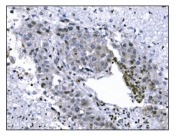 IHC staining of FFPE human liver cancer tissue with KMT1B antibody. HIER: boil tissue sections in pH8 EDTA for 20 min and allow to cool before testing.