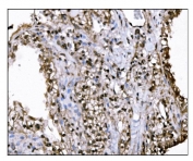 IHC staining of FFPE human renal clear cell carcinoma tissue with KMT1B antibody. HIER: boil tissue sections in pH8 EDTA for 20 min and allow to cool before testing.