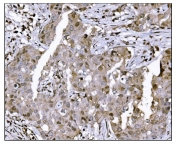 IHC staining of FFPE human breast invasive ductal cancer tissue with KMT1B antibody. HIER: boil tissue sections in pH8 EDTA for 20 min and allow to cool before testing.