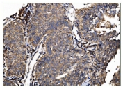 IHC staining of FFPE human lung cancer tissue with TBC1D4 antibody. HIER: boil tissue sections in pH8 EDTA for 20 min and allow to cool before testing.