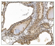 IHC staining of FFPE human renal clear cell carcinoma tissue with TBC1D4 antibody. HIER: boil tissue sections in pH8 EDTA for 20 min and allow to cool before testing.