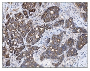 IHC staining of FFPE human gallbladder adenocarcinoma tissue with TBC1D4 antibody. HIER: boil tissue sections in pH8 EDTA for 20 min and allow to cool before testing.