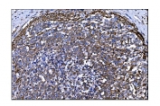 IHC staining of FFPE human gastric cancer tissue with Toll-like receptor 8 antibody. HIER: boil tissue sections in pH8 EDTA for 20 min and allow to cool before testing.