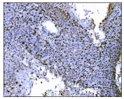 IHC staining of FFPE human liver cancer tissue with Ki-67 antibody. HIER: boil tissue sections in pH8 EDTA for 20 min and allow to cool before testing.