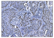 IHC staining of FFPE human lung cancer tissue with Ki-67 antibody. HIER: boil tissue sections in pH8 EDTA for 20 min and allow to cool before testing.