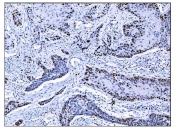 IHC staining of FFPE human esophageal squamous carcinoma tissue with Ki-67 antibody. HIER: boil tissue sections in pH8 EDTA for 20 min and allow to cool before testing.