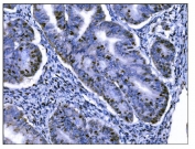 IHC staining of FFPE human cervical cancer tissue with Ki-67 antibody. HIER: boil tissue sections in pH8 EDTA for 20 min and allow to cool before testing.