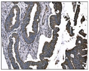 IHC staining of FFPE human cervical intraepithelial neoplasia tissue with TGF beta Receptor II antibody. HIER: boil tissue sections in pH8 EDTA for 20 min and allow to cool before testing.