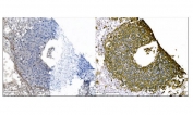 IHC staining of FFPE human liver cancer tissue with M6PR antibody (right) and PBS (left, negative control). HIER: boil tissue sections in pH8 EDTA for 20 min and allow to cool before testing.