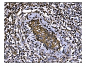 IHC staining of FFPE human gastric cancer tissue with M6PR antibody. HIER: boil tissue sections in pH8 EDTA for 20 min and allow to cool before testing.