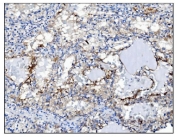 IHC staining of FFPE human renal clear cell carcinoma tissue with PGP9.5 antibody. HIER: boil tissue sections in pH8 EDTA for 20 min and allow to cool before testing.