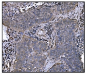 IHC staining of FFPE human lung cancer tissue with HSP90AA1 antibody. HIER: boil tissue sections in pH8 EDTA for 20 min and allow to cool before testing.