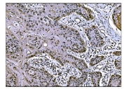 IHC staining of FFPE human esophageal squamous carcinoma tissue with COPS5 antibody. HIER: boil tissue sections in pH8 EDTA for 20 min and allow to cool before testing.