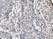 IHC staining of FFPE human lung cancer tissue with CCAR2 antibody. HIER: boil tissue sections in pH8 EDTA for 20 min and allow to cool before testing.
