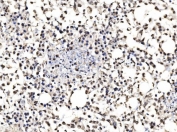 IHC staining of FFPE human pancreatic carcinoma tissue with CCAR2 antibody. HIER: boil tissue sections in pH8 EDTA for 20 min and allow to cool before testing.