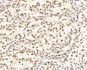 IHC staining of FFPE human renal clear cell carcinoma tissue with CCAR2 antibody. HIER: boil tissue sections in pH8 EDTA for 20 min and allow to cool before testing.
