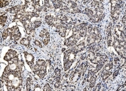 IHC staining of FFPE human gall bladder adenosquamous carcinoma tissue with CCAR2 antibody. HIER: boil tissue sections in pH8 EDTA for 20 min and allow to cool before testing.