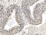IHC staining of FFPE human liver cancer tissue with CCAR2 antibody. HIER: boil tissue sections in pH8 EDTA for 20 min and allow to cool before testing.