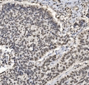 IHC staining of FFPE human laryngeal carcinoma tissue with CCAR2 antibody. HIER: boil tissue sections in pH8 EDTA for 20 min and allow to cool before testing.