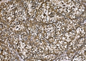 IHC staining of FFPE human renal clear cell carcinoma tissue with DLAT antibody. HIER: boil tissue sections in pH8 EDTA for 20 min and allow to cool before testing.