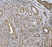 IHC staining of FFPE human liver cancer tissue with DLAT antibody. HIER: boil tissue sections in pH8 EDTA for 20 min and allow to cool before testing.