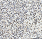 IHC staining of FFPE human lymphadenoma tissue with EDC4 antibody. HIER: boil tissue sections in pH8 EDTA for 20 min and allow to cool before testing.