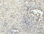 IHC staining of FFPE human colorectal cancer tissue with EDC4 antibody. HIER: boil tissue sections in pH8 EDTA for 20 min and allow to cool before testing.