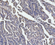 IHC staining of FFPE human colorectal adenocarcinoma tissue with EDC4 antibody. HIER: boil tissue sections in pH8 EDTA for 20 min and allow to cool before testing.