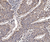 IHC staining of FFPE human liver cancer tissue with GGA3 antibody. HIER: boil tissue sections in pH8 EDTA for 20 min and allow to cool before testing.