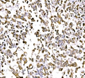 IHC staining of FFPE human pancreatic cancer tissue with GGA3 antibody. HIER: boil tissue sections in pH8 EDTA for 20 min and allow to cool before testing.