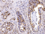 IHC staining of FFPE human gall bladder adenosquamous carcinoma tissue with Geminin antibody. HIER: boil tissue sections in pH8 EDTA for 20 min and allow to cool before testing.