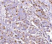 IHC staining of FFPE human gall bladder adenosquamous carcinoma tissue with Geminin antibody. HIER: boil tissue sections in pH8 EDTA for 20 min and allow to cool before testing.