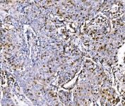 IHC staining of FFPE human lung cancer tissue with Geminin antibody. HIER: boil tissue sections in pH8 EDTA for 20 min and allow to cool before testing.