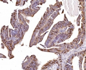 IHC staining of FFPE human rectal cancer tissue with Geminin antibody. HIER: boil tissue sections in pH8 EDTA for 20 min and allow to cool before testing.