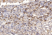 IHC staining of FFPE human laryngeal squamous cell carcinoma tissue with Geminin antibody. HIER: boil tissue sections in pH8 EDTA for 20 min and allow to cool before testing.